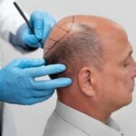 Why DHI Hair Transplants Are Gaining Popularity
